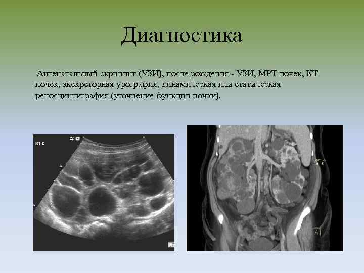 Диагностика Антенатальный скрининг (УЗИ), после рождения - УЗИ, МРТ почек, КТ почек, экскреторная урография,