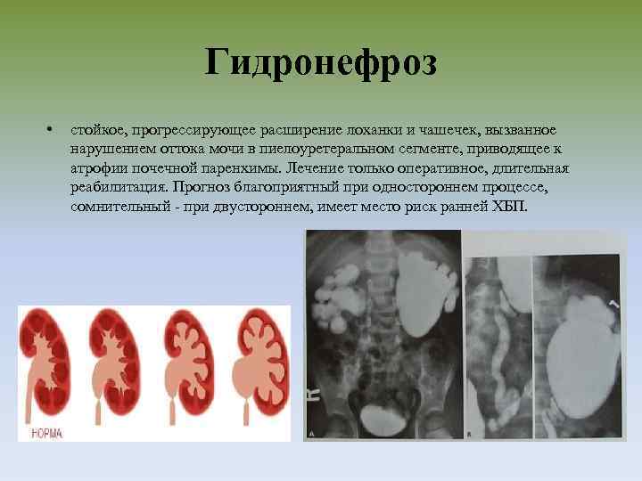 Гидронефроз • стойкое, прогрессирующее расширение лоханки и чашечек, вызванное нарушением оттока мочи в пиелоуретеральном