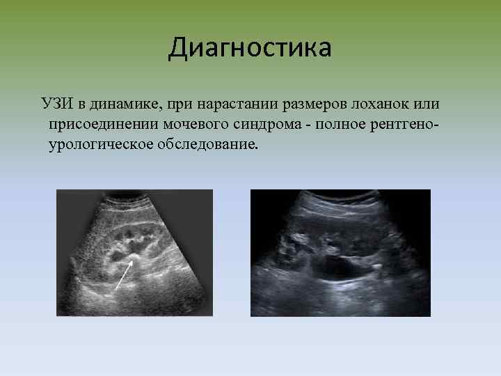 Диагностика УЗИ в динамике, при нарастании размеров лоханок или присоединении мочевого синдрома - полное