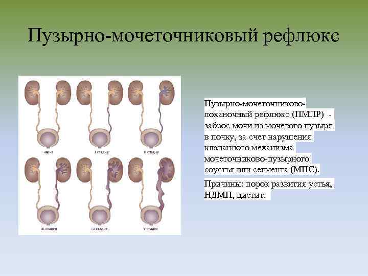 Пузырно-мочеточниковый рефлюкс Пузырно-мочеточниковолоханочный рефлюкс (ПМЛР) заброс мочи из мочевого пузыря в почку, за счет