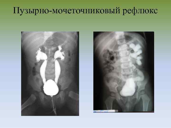 Пузырно-мочеточниковый рефлюкс 