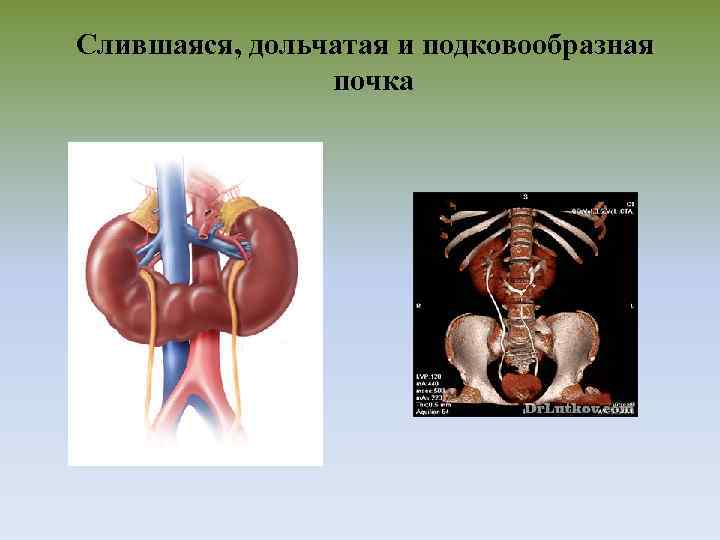 Слившаяся, дольчатая и подковообразная почка 