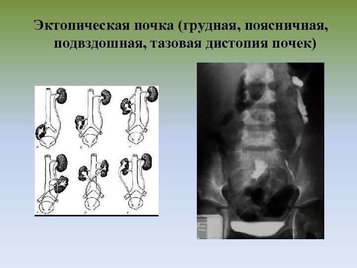 Эктопическая почка (грудная, поясничная, подвздошная, тазовая дистопия почек) 