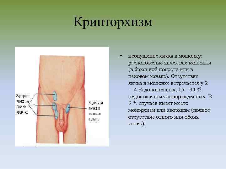 Крипторхизм • неопущение яичка в мошонку: расположение яичек вне мошонки (в брюшной полости или