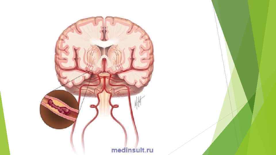 Тромбозы сосудов головного. Церебральный венозный тромбоз. Тромбоэмболия сосудов головного мозга. Тромбоз мозговых артерий. Эмболия мозговых сосудов.