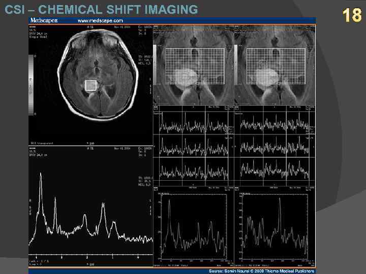 CSI – CHEMICAL SHIFT IMAGING 18 