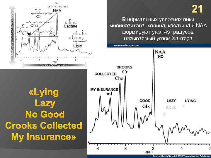 21 В нормальных условиях пики миоинозитола, холина, креатина и NAA формируют угол 45 градусов,