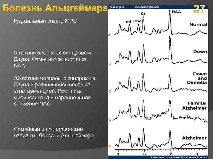 Болезнь Альцгеймера Нормальный спектр МРС 5 -летний ребёнок с синдромом Дауна. Отмечается рост пика