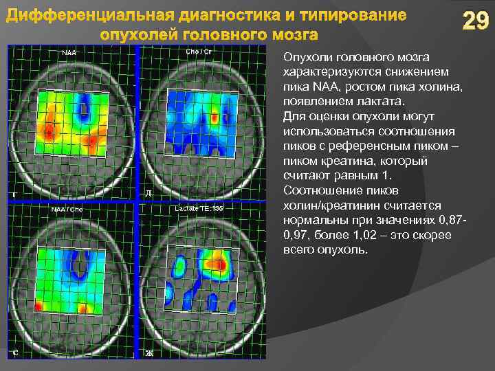 Дифференциальная диагностика и типирование опухолей головного мозга 29 Опухоли головного мозга характеризуются снижением пика