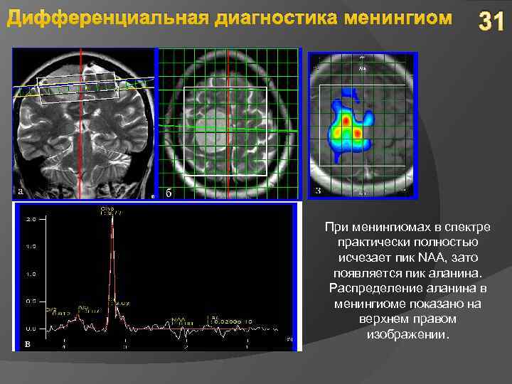 Дифференциальная диагностика менингиом 31 При менингиомах в спектре практически полностью исчезает пик NAA, зато