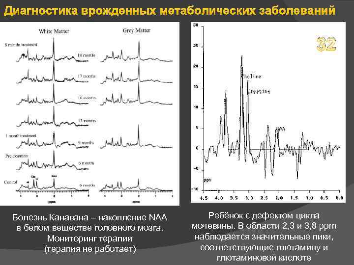 Диагностика врожденных метаболических заболеваний 32 Болезнь Канавана – накопление NAA в белом веществе головного