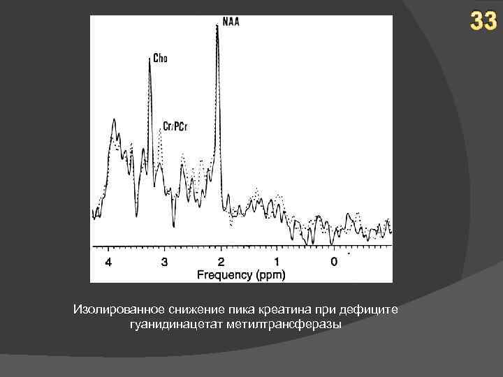 33 Изолированное снижение пика креатина при дефиците гуанидинацетат метилтрансферазы 