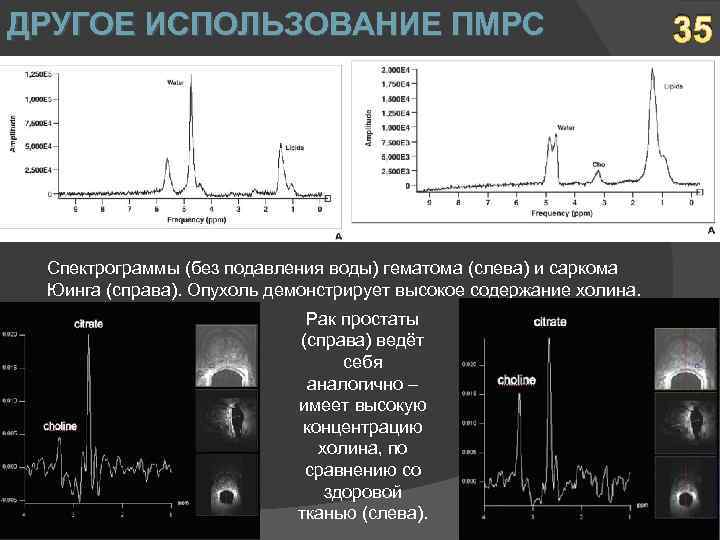 ДРУГОЕ ИСПОЛЬЗОВАНИЕ ПМРС Спектрограммы (без подавления воды) гематома (слева) и саркома Юинга (справа). Опухоль