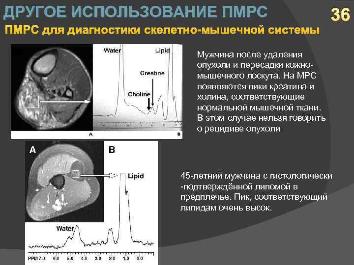 ДРУГОЕ ИСПОЛЬЗОВАНИЕ ПМРС для диагностики скелетно-мышечной системы 36 Мужчина после удаления опухоли и пересадки