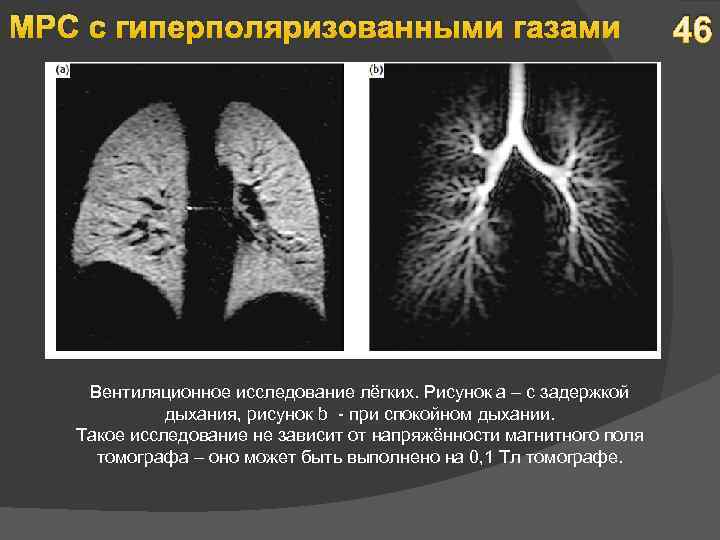 МРС с гиперполяризованными газами Вентиляционное исследование лёгких. Рисунок а – с задержкой дыхания, рисунок