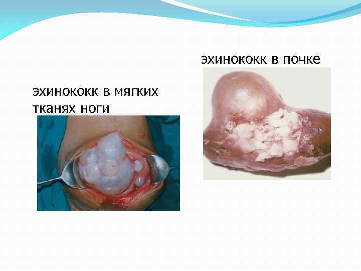 эхинококк в почке эхинококк в мягких тканях ноги 