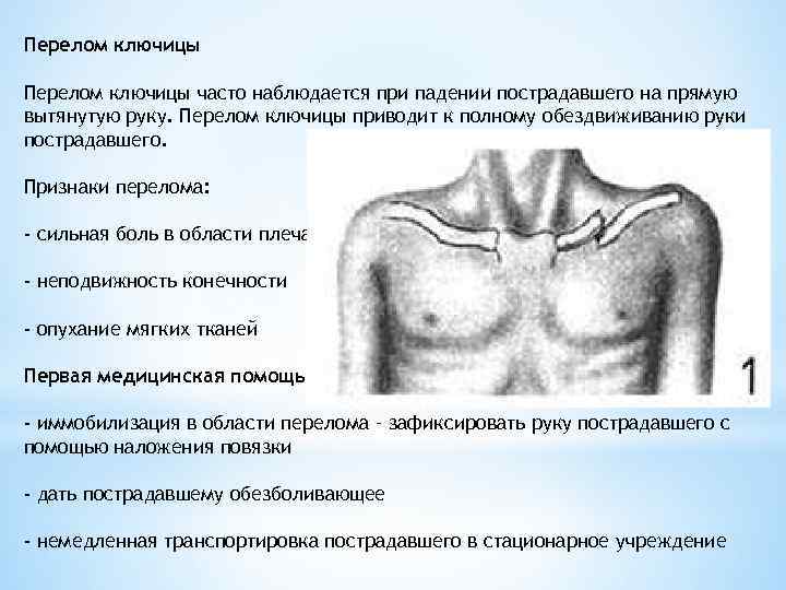 Перелом ключицы часто наблюдается при падении пострадавшего на прямую вытянутую руку. Перелом ключицы приводит