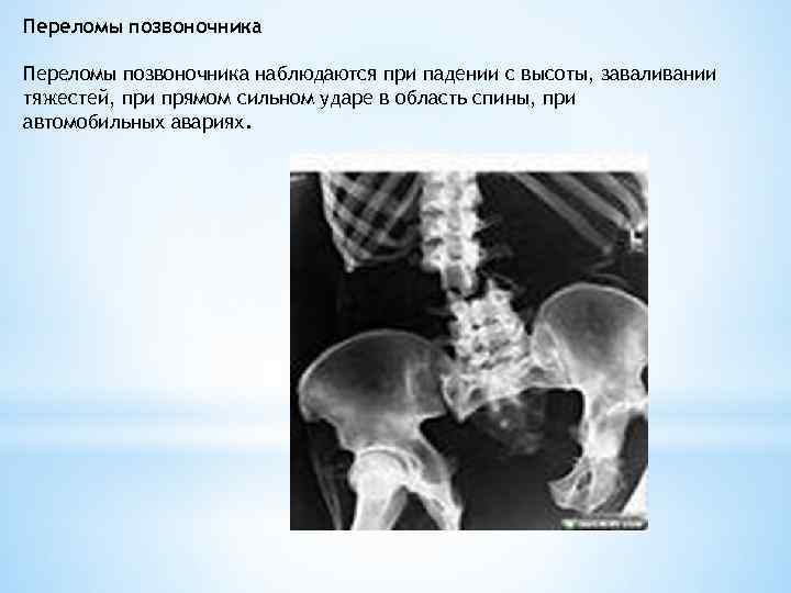 Переломы позвоночника наблюдаются при падении с высоты, заваливании тяжестей, при прямом сильном ударе в