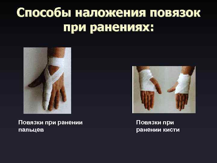 Способы наложения повязок при ранениях: Повязки при ранении пальцев Повязки при ранении кисти 