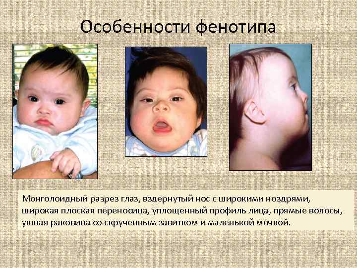Фенотип ребенка с синдромом дауна. Монголоидный разрез глаз синдром Дауна. Глаза у детей с синдромом Дауна. Фенотипический синдром Дауна.