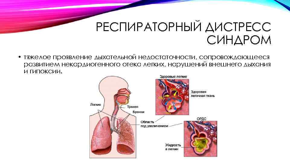 Дистресс синдром презентация