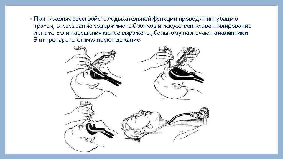  • При тяжелых расстройствах дыхательной функции проводят интубацию трахеи, отсасывание содержимого бронхов и