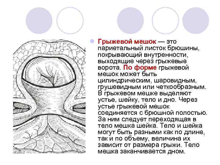 l Грыжевой мешок — это париетальный листок брюшины, покрывающий внутренности, выходящие через грыжевые ворота.