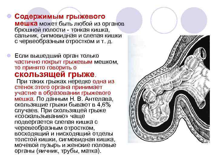 l Содержимым грыжевого мешка может быть любой из органов брюшной полости - тонкая кишка,