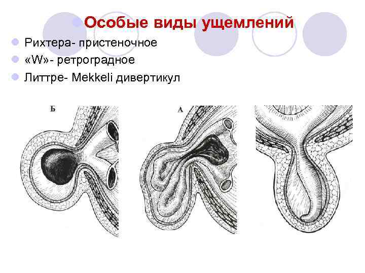 l Особые виды ущемлений l Рихтера- пристеночное l «W» - ретроградное l Литтре- Mekkeli