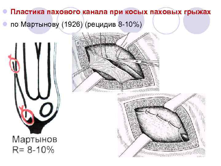 l Пластика пахового канала при косых паховых грыжах l по Мартынову (1926) (рецидив 8