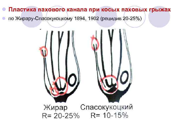 Пластика пахового канала по мартынову