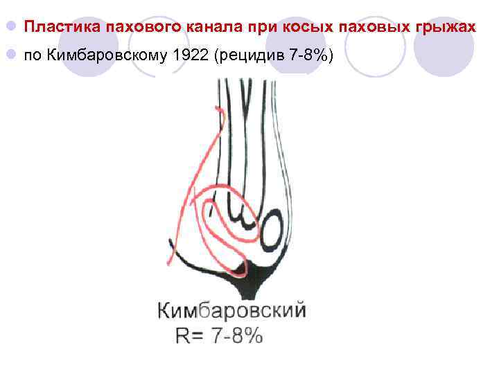 Пластика пахового канала по кимбаровскому