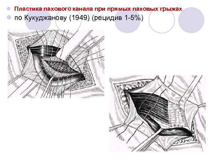 Схемы пластики пахового канала