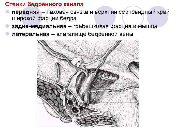 Стенки бедренного канала l передняя – паховая связка и верхний серповидный край широкой фасции