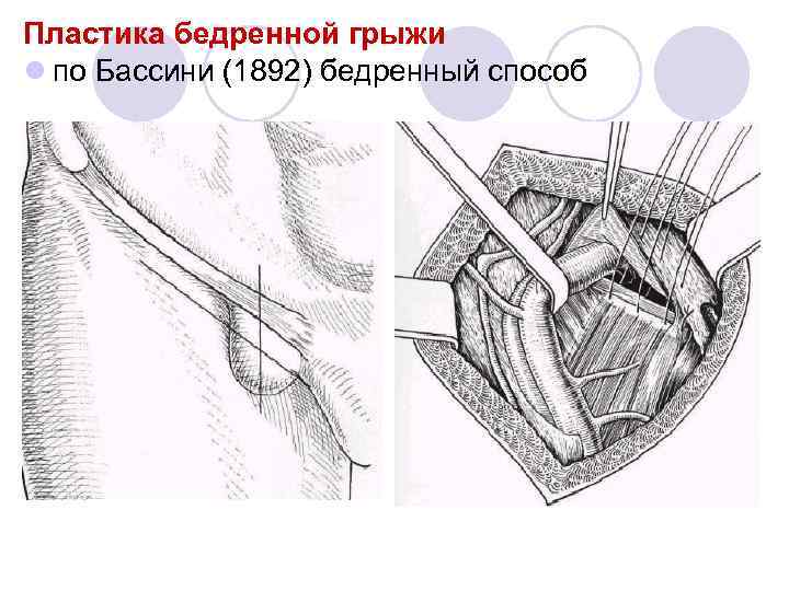 Пластика по бассини при паховой грыже