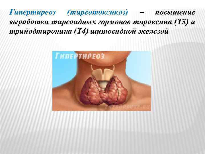 Гипертиреоз (тиреотоксикоз) – повышение выработки тиреоидных гормонов тироксина (T 3) и трийодтиронина (T 4)