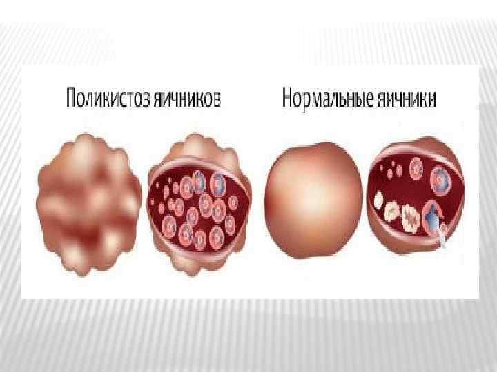 Фото яичников при поликистозе яичников