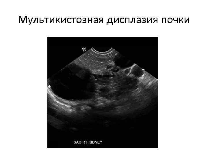 Дисплазия почки презентация