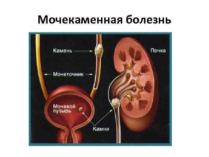 Мочекаменная болезнь 