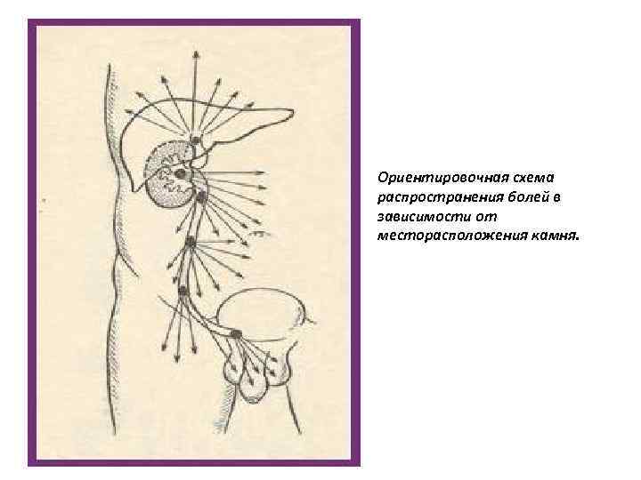 Ориентировочная схема распространения болей в зависимости от месторасположения камня. 