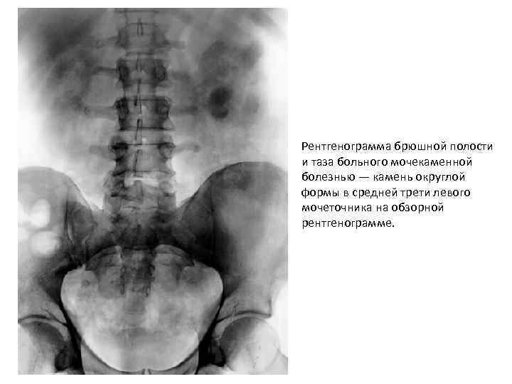 Рентгенография органов брюшной полости. Экскреторная урография туберкулез. Обзорная рентгенография ОБП. Конкременты в брюшной полости рентген. Обзорная рентгеноскопия брюшной полости.