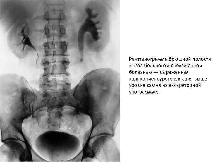 Рентгенограмма брюшной полости и таза больного мочекаменной болезнью — выраженная каликопиелоуретерэктазия выше уровня камня