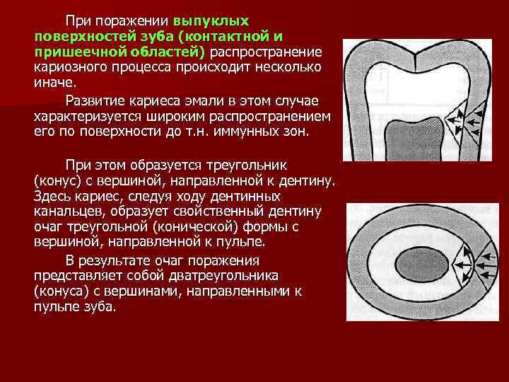 При поражении выпуклых поверхностей зуба (контактной и пришеечной областей) распространение кариозного процесса происходит несколько