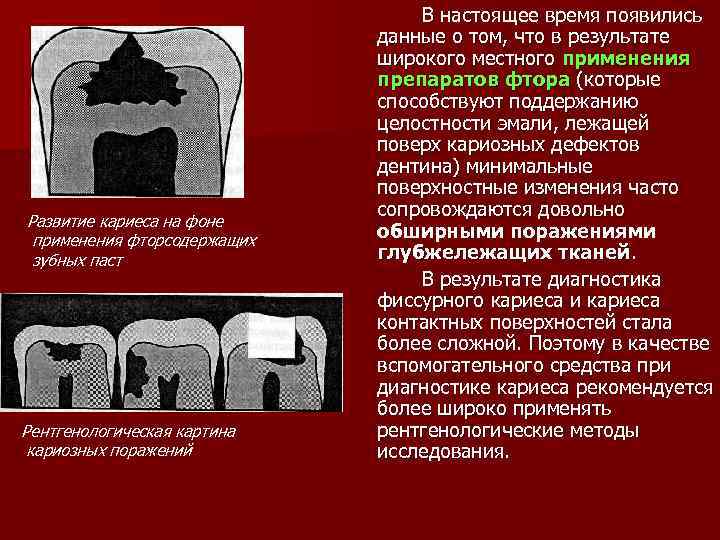 Развитие кариеса на фоне применения фторсодержащих зубных паст Рентгенологическая картина кариозных поражений В настоящее