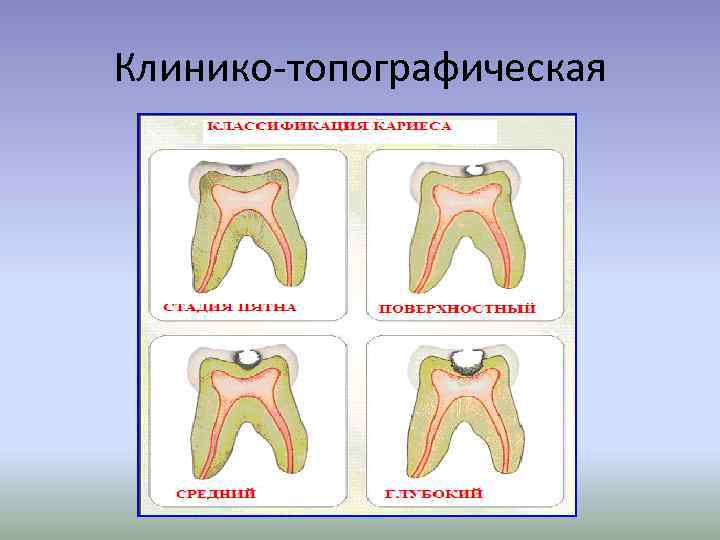 Клинико-топографическая 