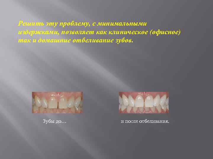 Решить эту проблему, с минимальными издержками, позволяет как клиническое (офисное) так и домашние отбеливание