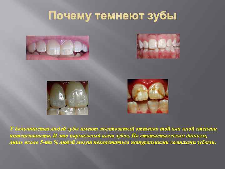 Почему темнеют зубы У большинства людей зубы имеют желтоватый оттенок той или иной степени