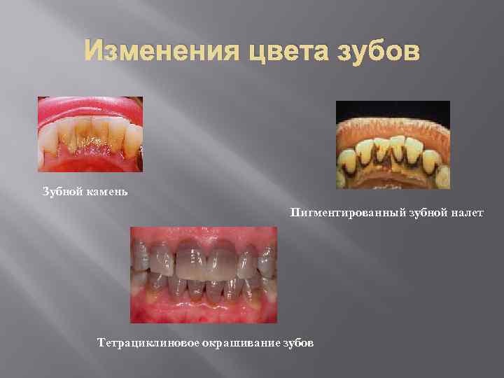 Изменения цвета зубов Зубной камень Пигментированный зубной налет Тетрациклиновое окрашивание зубов 