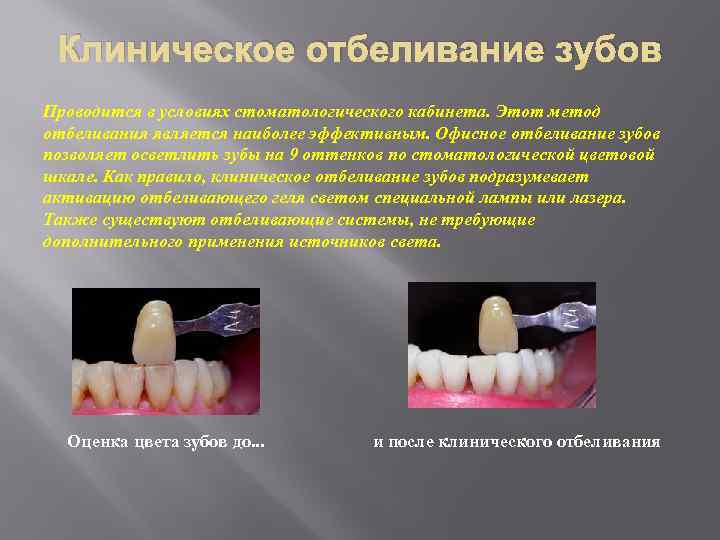 Отбеливание зубов презентации цена отбеливания зубов в минске