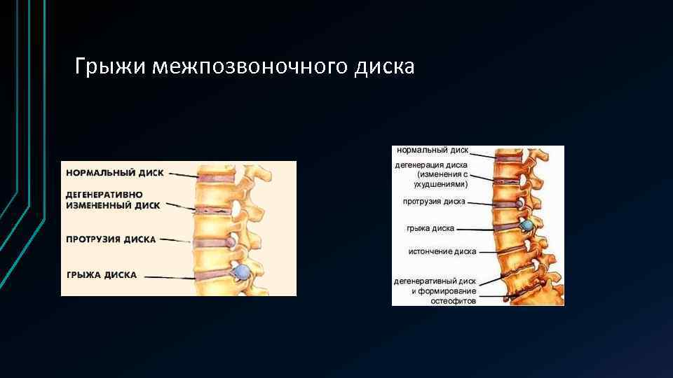 Грыжа межпозвонковых дисков презентация